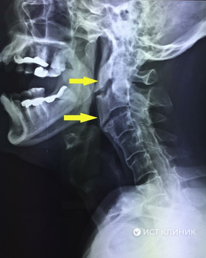 Болезнь форестье (ДИОГ): полное руководство по причинам, симптомам, диагностике и лечению