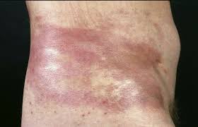 Локализованная склеродермия (морфеа): полное руководство по причинам, симптомам, диагностике и лечению