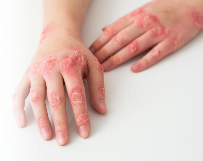 Эозинофильный фасциит (ЭФ): полное руководство по диагностике и эффективному лечению