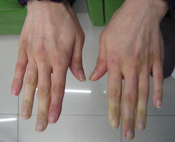 Недифференцированное заболевание соединительной ткани (НЗСТ): полный путеводитель