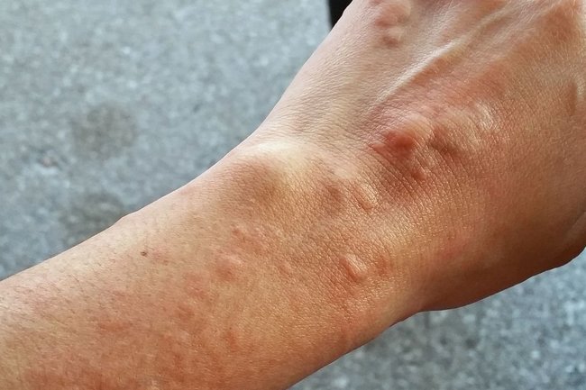 Уртикарный васкулит: полное руководство по диагностике и современному лечению