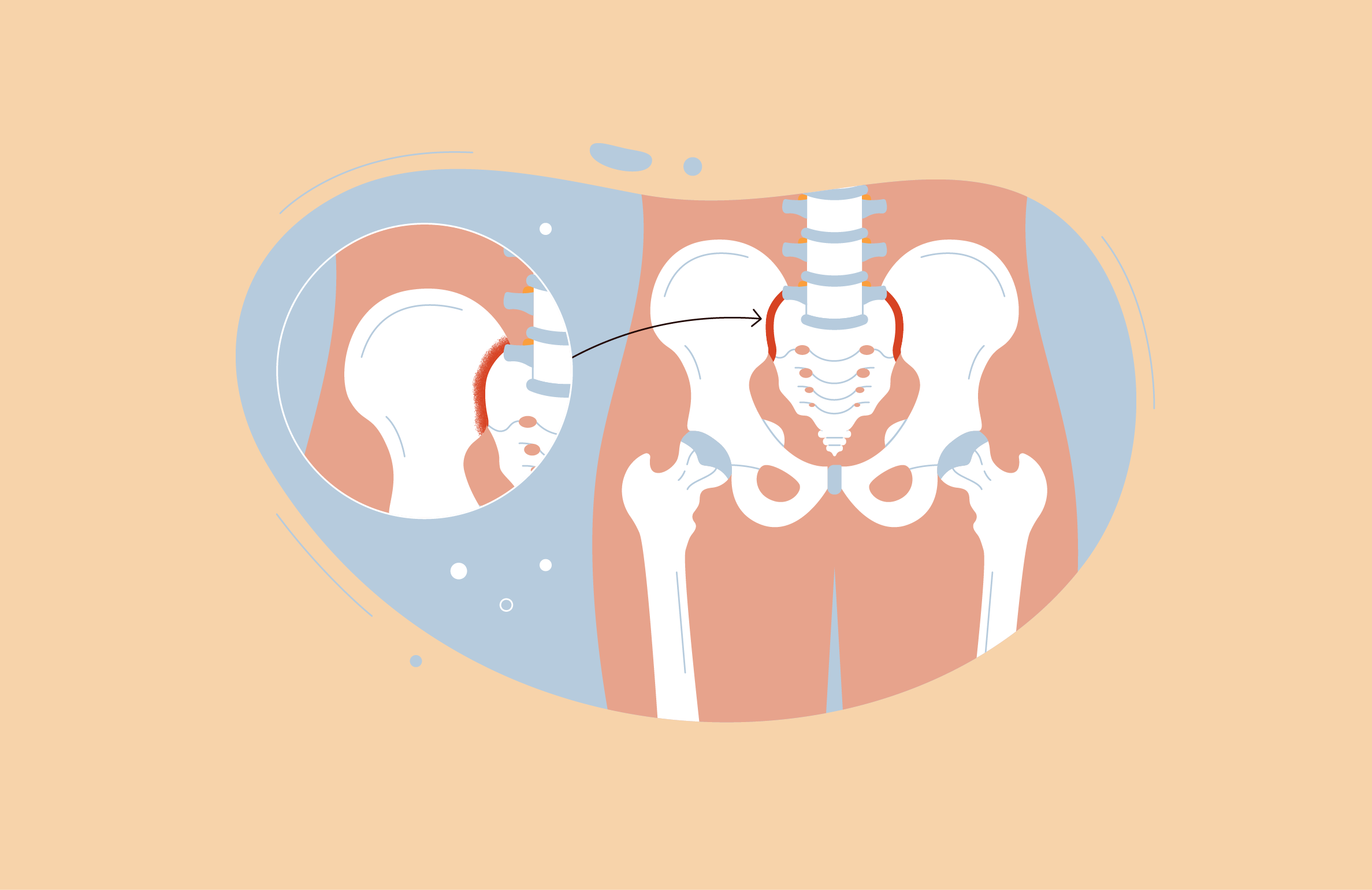 Аксиальный спондилоартрит: полное руководство по симптомам, диагностике и лечению