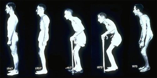 Периферический спондилоартрит: причины, симптомы, диагностика и лечение