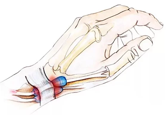 Болезнь де кервена: полное руководство по причинам, симптомам и лечению