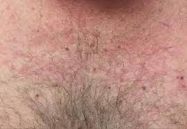 TRAPS-синдром: полное руководство по наследственному аутовоспалительному заболеванию