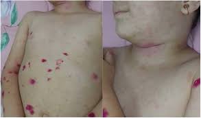 Гипер-igD синдром (HIDS): полное руководство по диагностике, лечению и жизни