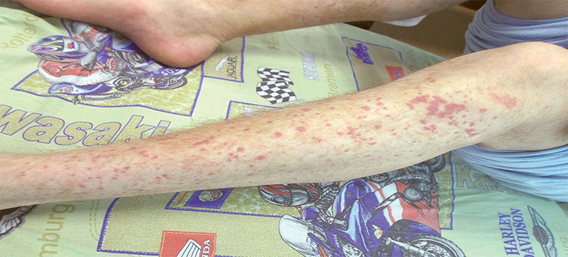 Кожный лейкоцитокластический васкулит: причины, симптомы, методы диагностики и тактика лечения