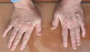 Антисинтетазный синдром: полное руководство по симптомам, диагностике и лечению