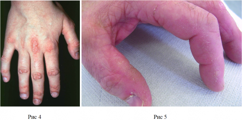 Некротизирующая аутоиммунная миопатия: полное руководство по диагностике и лечению