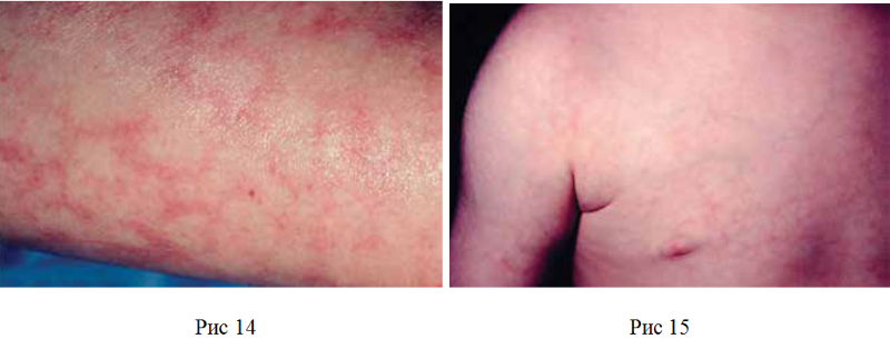 Миозит с включениями: полное руководство по причинам, симптомам, диагностике и лечению