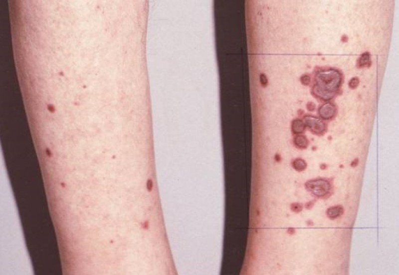 Узловатая эритема: полное руководство по диагностике и эффективному лечению