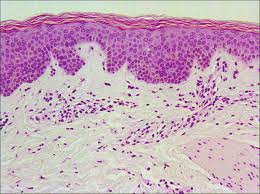 Синдром шнитцлер: полное руководство по симптомам, диагностике и современному лечению