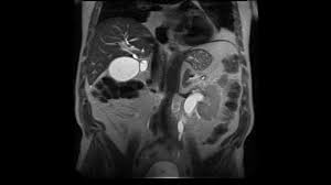 Ретроперитонеальный фиброз (болезнь ормонда): полное руководство