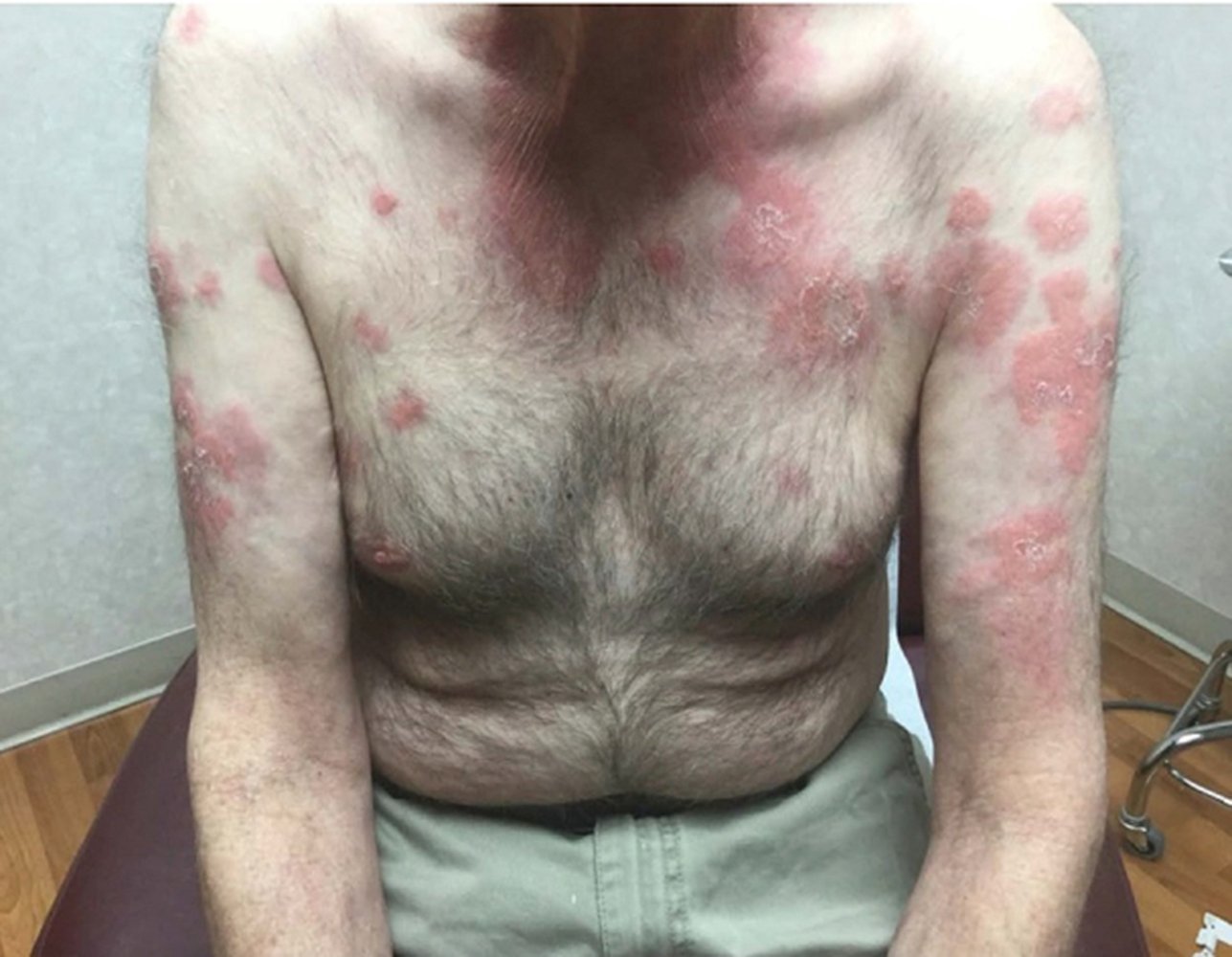 VEXAS-синдром: полное руководство по диагностике и лечению редкой аутовоспалительной болезни