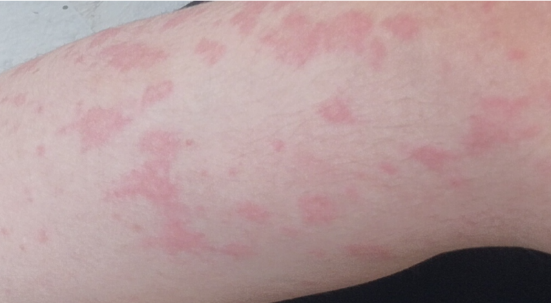 Криопирин-ассоциированные синдромы: полное руководство по диагностике и лечению