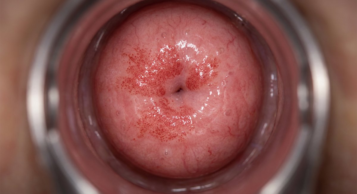 Эктопия шейки матки у подростков: полное руководство для родителей и девочек